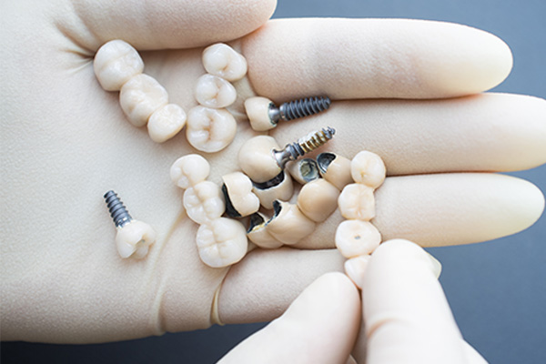 Dental-implants-in-chennai