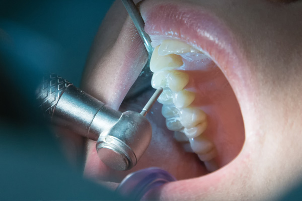 Best dental filling clinic in Mugalivakkam