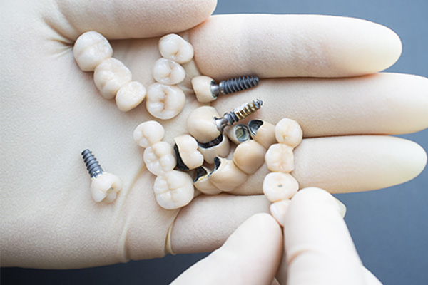 Best dental implants in chennai