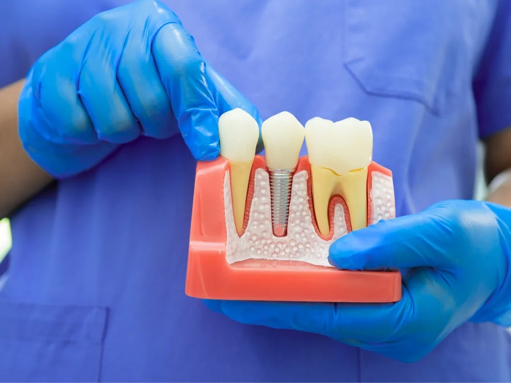 Best Dental Implants in Chennai at Srivari Dental Clinic - srivarichennaidentalclinic