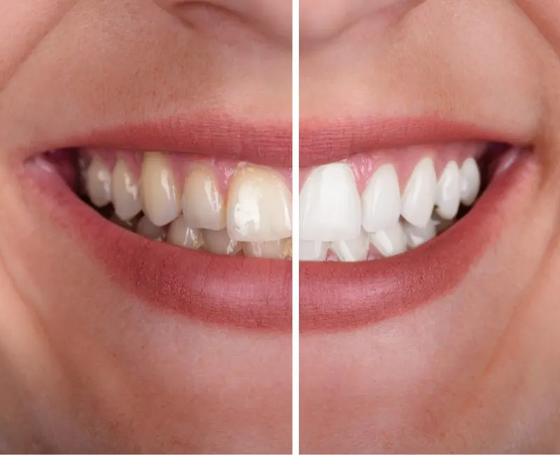 Full Mouth Rehabilitation at Srivari Dental Clinic - srivarichennaidentalclinic Full Mouth Rehabilitation In Chennai at Srivari Dental Clinic